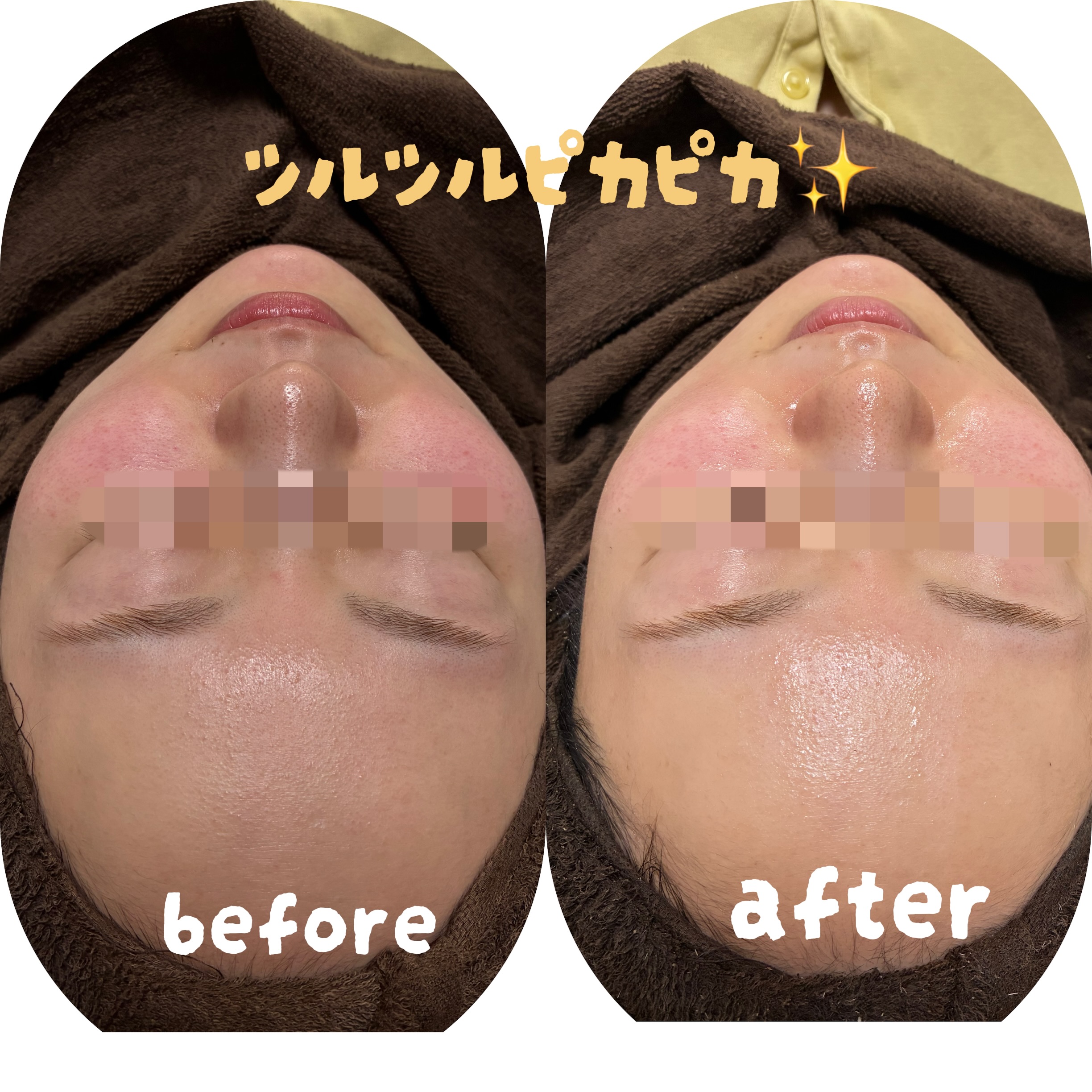 REVIVE 純国産ハーブピーリングの画像