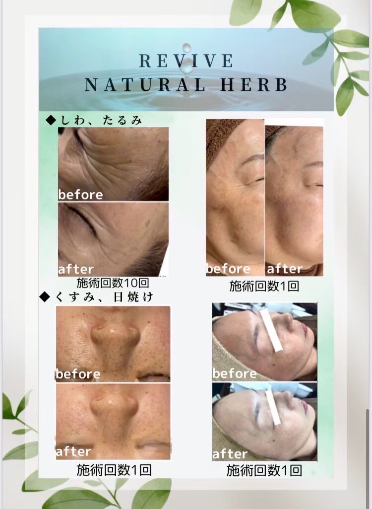 REVIVE 純国産ハーブピーリングの画像